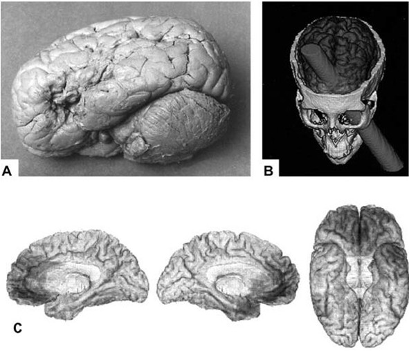 1862 - Broca és betege; Tan